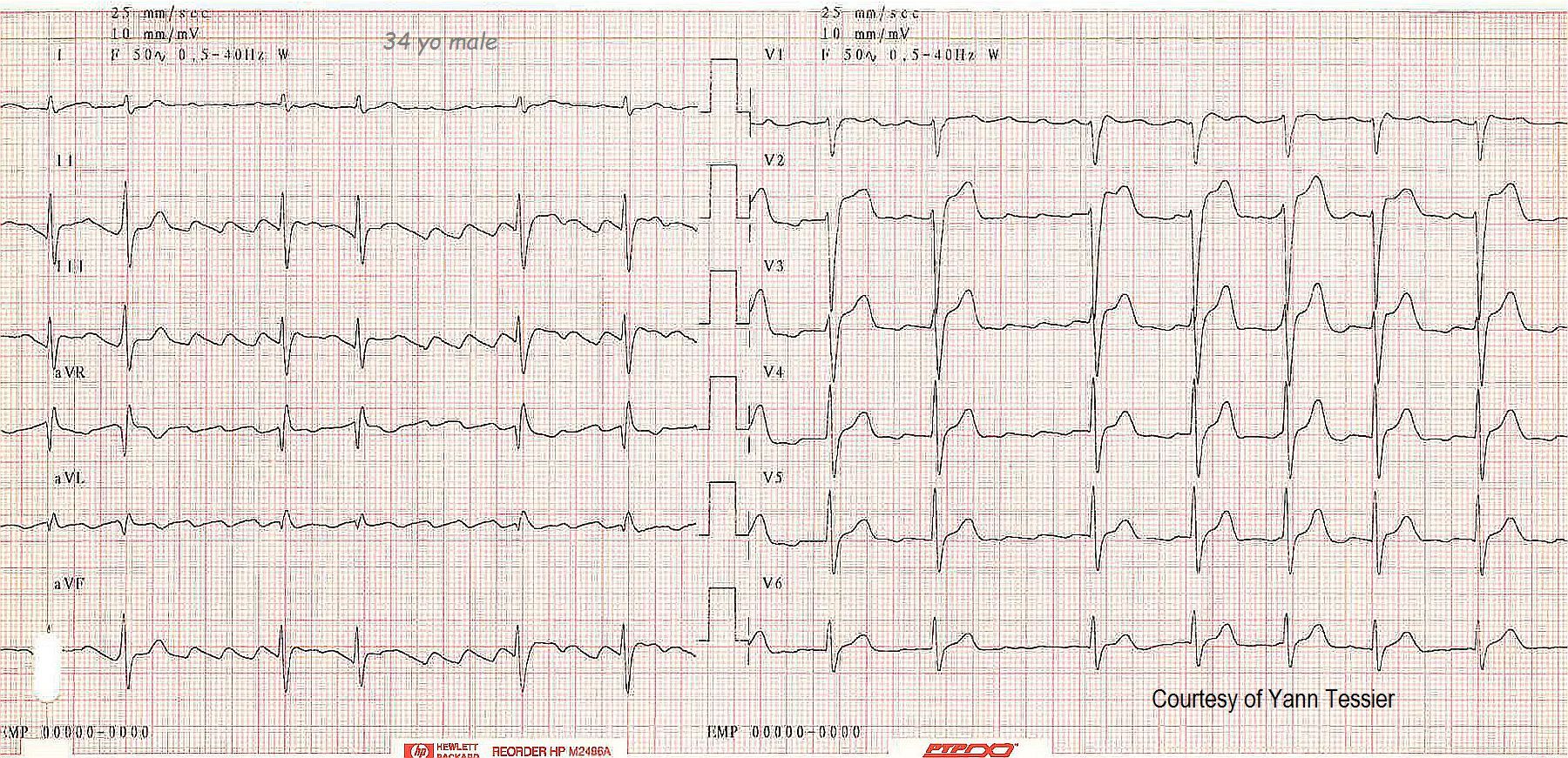 Ecg Teaching Series Atrial Flutter Ecg Guru Instructor Resources 2651